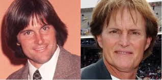Bruce Jenner Before and After Surgery